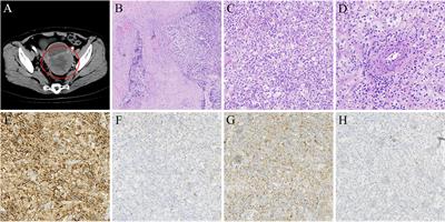 Anti-PD-1 immunotherapy combined with stereotactic body radiation therapy and GM-CSF for the treatment of advanced malignant PEComa: A case report